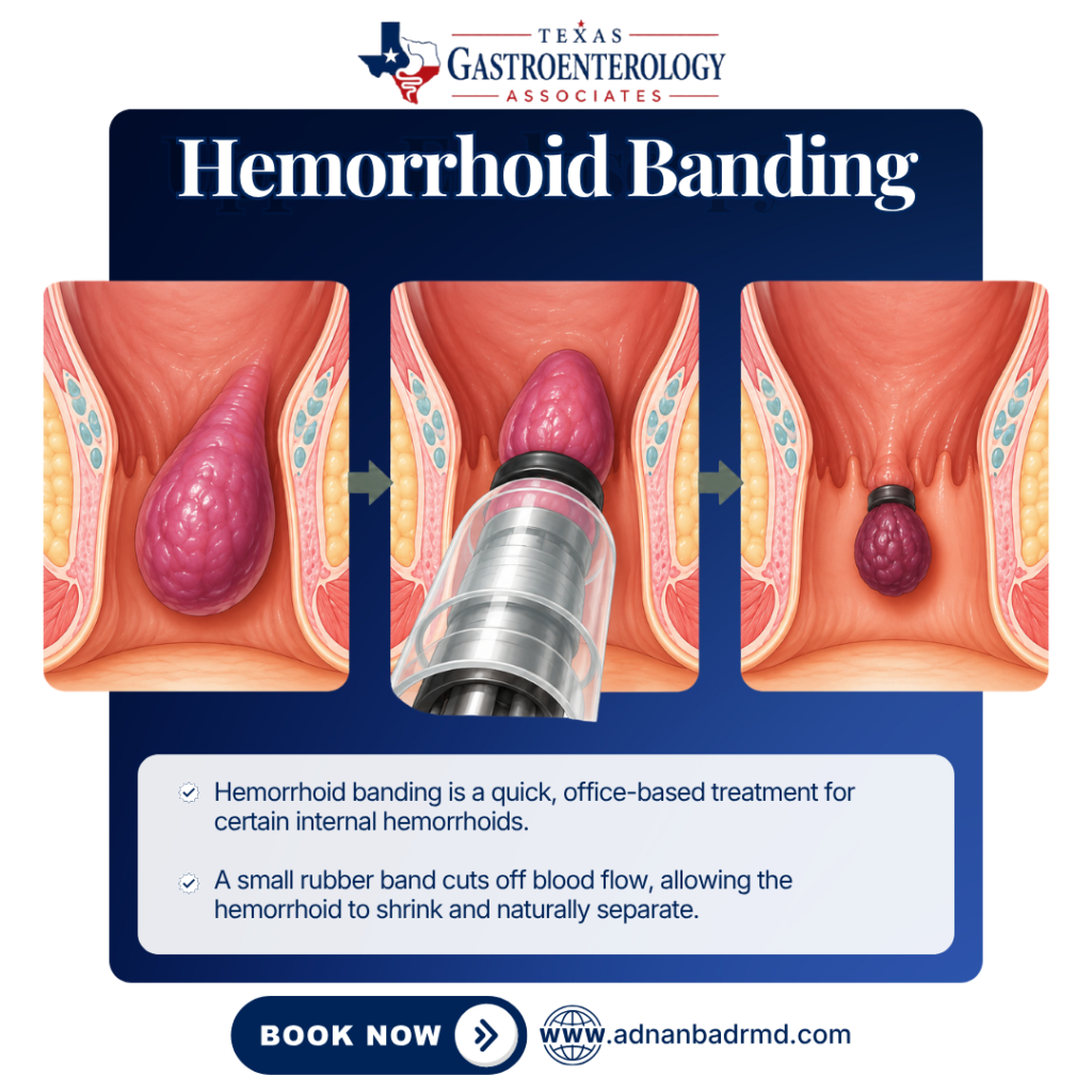 Hemorrhoid Banding